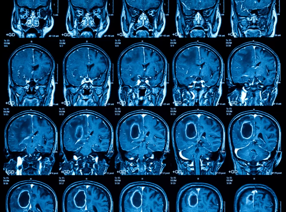 Neurolodzy: Polska nie jest gotowa zmierzyć się z wyzwaniem, jakim są choroby mózgu