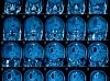 Neurolodzy: Polska nie jest gotowa zmierzyć się z wyzwaniem, jakim są choroby mózgu