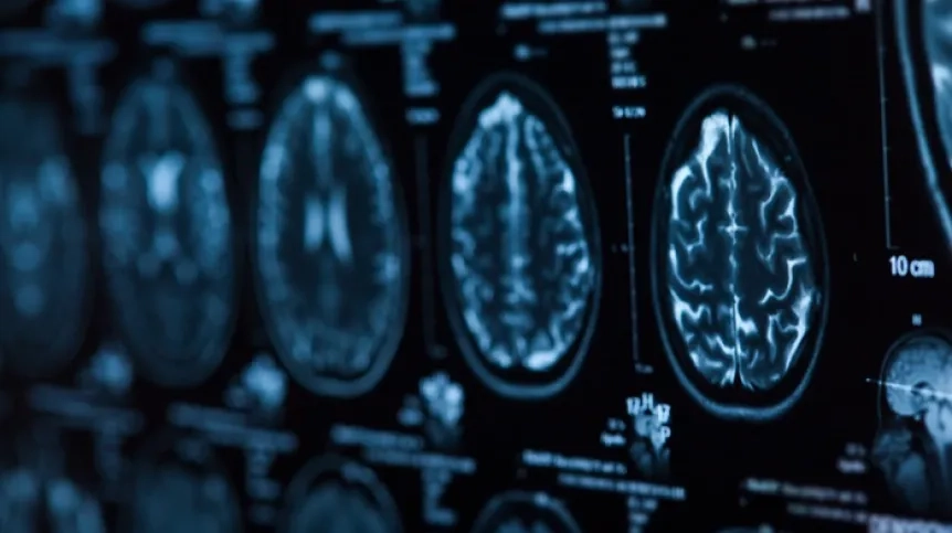 Podkarpackie/ Mieleccy neurochirurdzy zoperowali glejaka w obszarze ruchowym mózgu