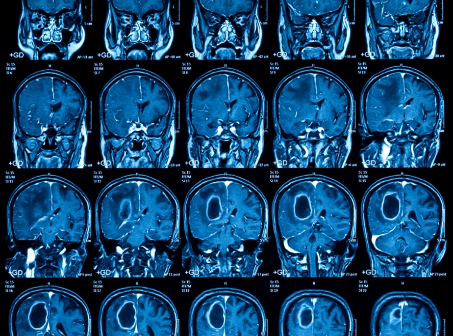Neurolodzy: Polska nie jest gotowa zmierzyć się z wyzwaniem, jakim są choroby mózgu