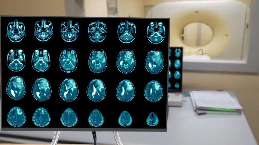 Neurochirurg: glejak wciąż jest jednym z najtrudniejszych nowotworów do leczenia